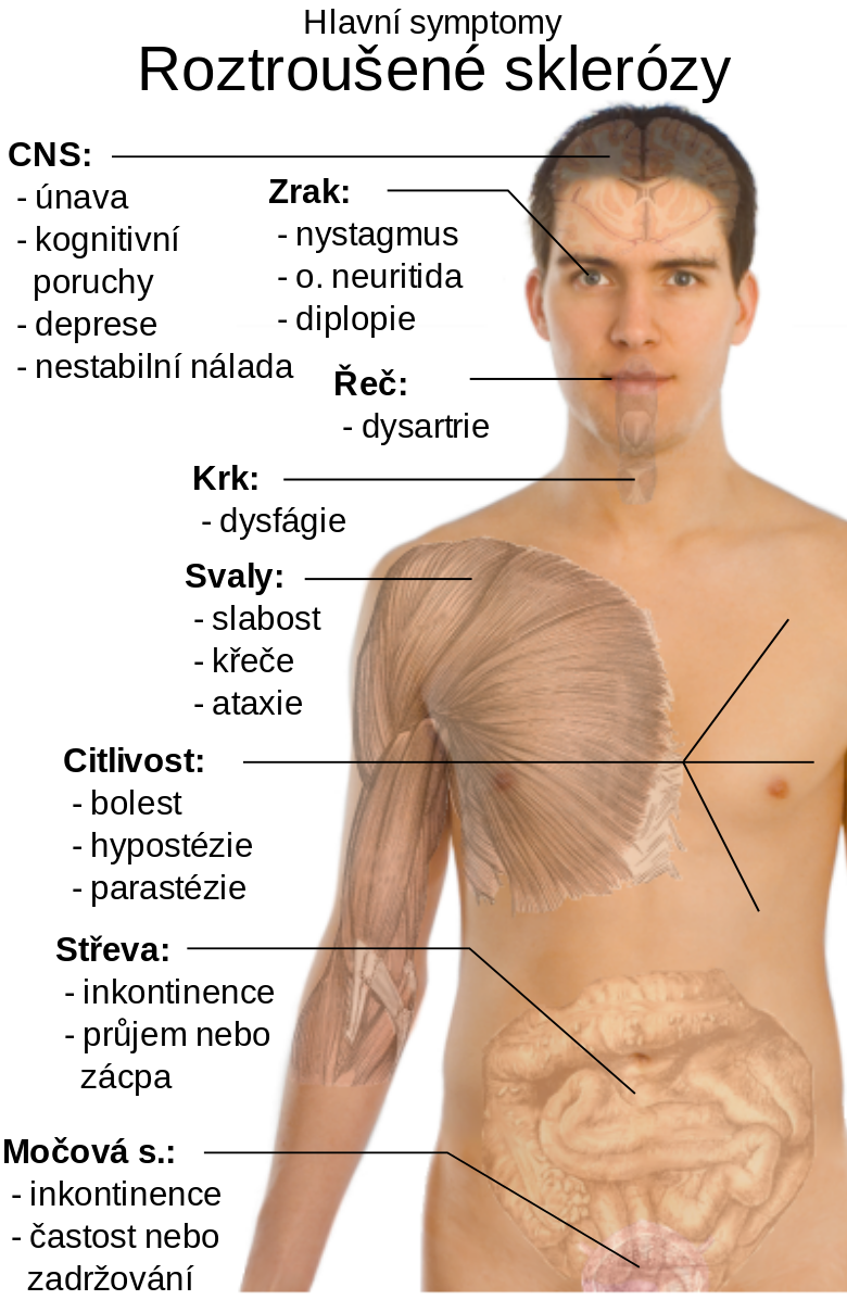 Jak se projevuje Roztrousena Skleroza?